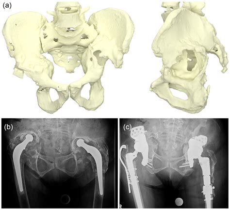 The Diagnosis And Treatment Of Acetabular Bone Loss In Revision Hip