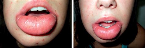 Lower Lips Swelling