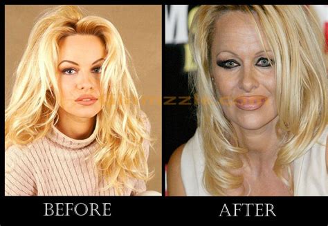 Celebrity Before And After Plastic Surgery Before And After Pictures Of