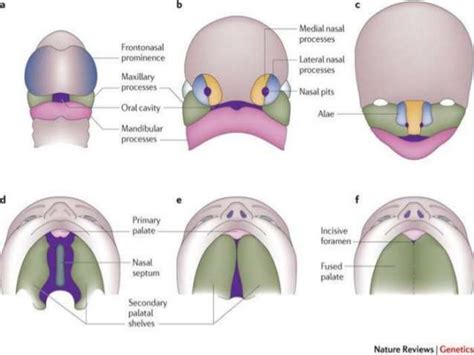 Cleft Lip And Cleft Palate Embryology Features And Management