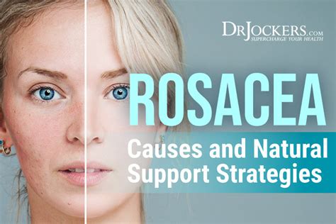 Rosacea Causes And Natural Support Strategies