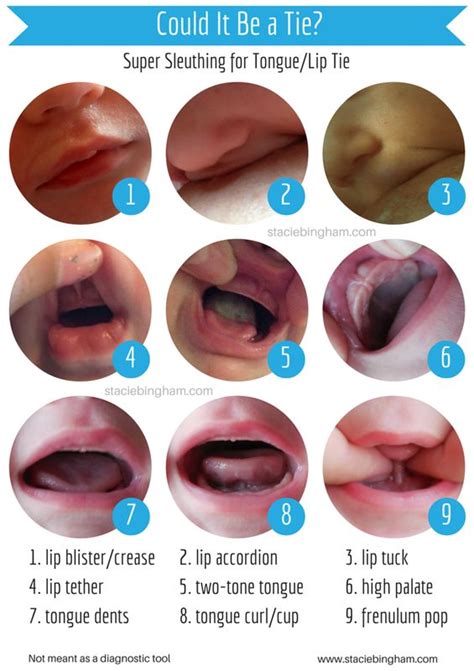 When Wondering If Your Baby Might Have A Tongue Tie Or Lip Tie Many