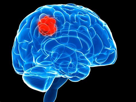 Signs And Symptoms Of Brain Tumors You Should Know