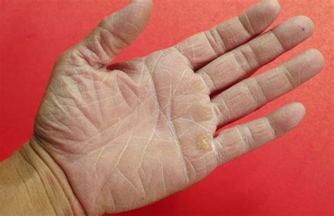 Rough Severely Dry Skin On Hand Causes And Treatment Skincarederm