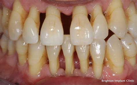 What Is Perio Halesowen Dental