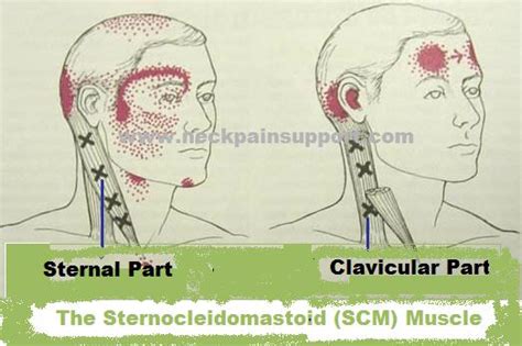 The Scm Muscle In The Neck It Doesnt Typically Cause Neck Pain But