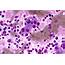 Imprint Cytology Shows Large Histiocytes Arrow With V  Open I