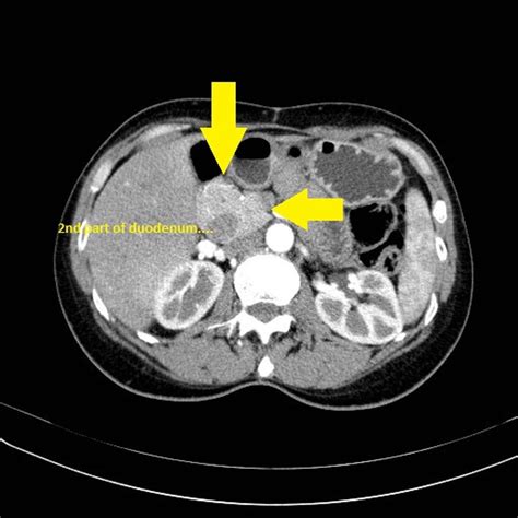 What Does Pancreatic Cancer Look Like On A Ct Scan What Does