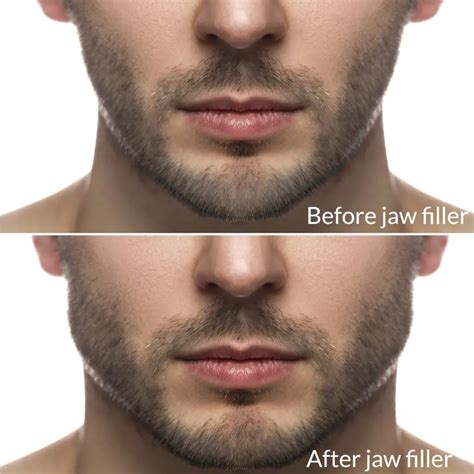 Male Injectables How To Achieve The Desired Jawline Skn Clinics