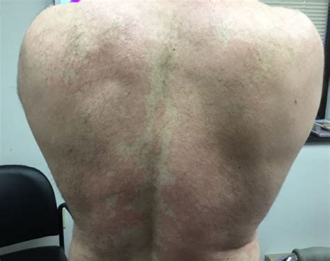 Derm Dx Can You Diagnose This Patients Rash Clinical Advisor