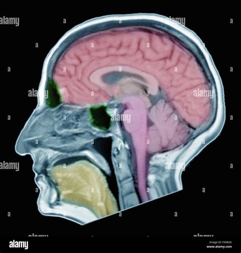 Mri Scan Of Normal Brain Fotos Und Bildmaterial In Hoher Aufl Sung