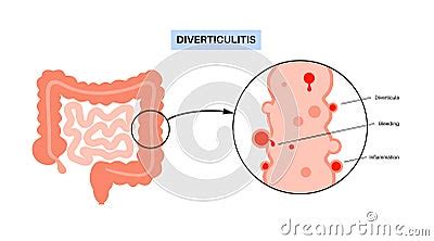 Diverticulitis And Diverticulosis Vector Illustration Cartoondealer