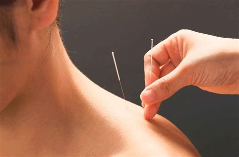 Acupuncture Treatment: What are the Benefits of Acupuncture?| Avaana