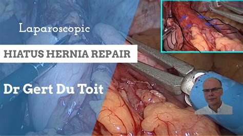Laparoscopic Hiatus Hernia Repair Dr Gert Du Toit Specialist Surgeon