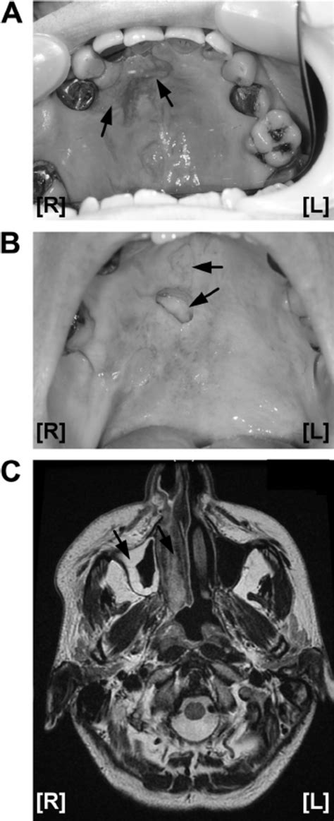 A And B Photographs Of The Hard Palate Of A Patient With Necrotizing