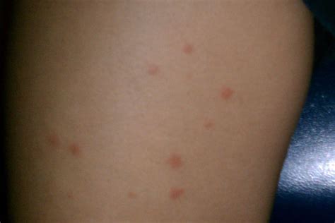 Derm Dx Symmetrical Pink Papules On The Cheeks Arms And Legs