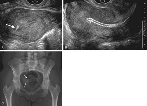 Ultrasound Evaluation Of The Fallopian Tube Obgyn Key