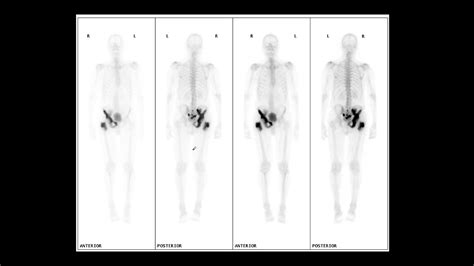 Bone Scintigraphy Iv Benign Bone Lesions Youtube