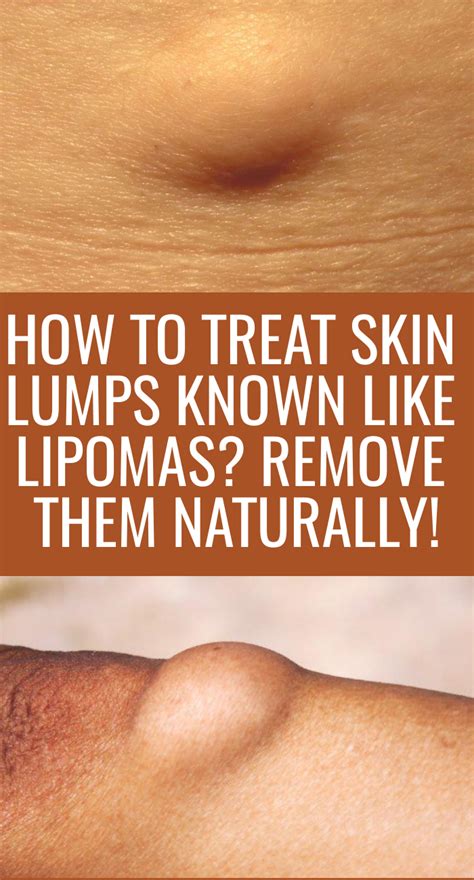 How To Treat Skin Lumps Known Like Lipomas Remove Them Naturally