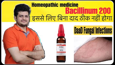 Best Homeopathic Medicine For Fungal Infection Ringworm Or Tinea
