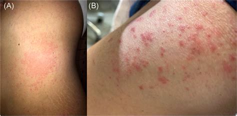 Skin Rashes After Sars‐cov‐2 Vaccine Which Relationship If Any