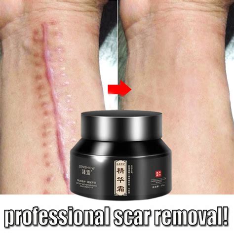 Scar Remover Cream Pimple Stretch Mark Remover 50g Skin Care Old Scar