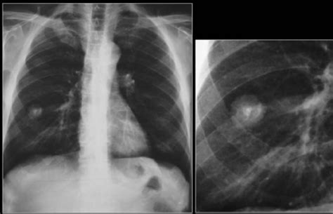 A Chest Radiograph Shows A Fairly Well Defined Pn In Th Open I