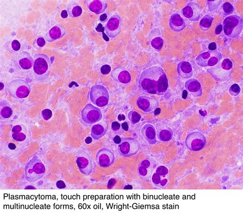 Pathology Outlines Plasmacytoma