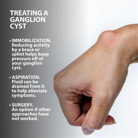 Ganglion Cyst Wrist Treatment Florida Orthopaedic Institute