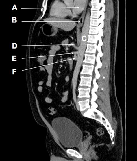Sagittal Computed Tomogram Of The Abdomen And Pelvis The Bmj