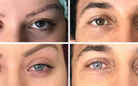 Operacion De Ojos Con Laser Precio Mexico Consejos Ojos