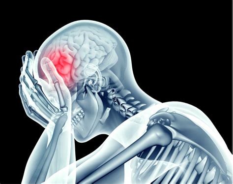 What Is Pcs Post Concussion Syndrome