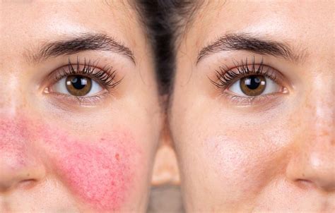 Is Your Facial Redness Rosacea Apex Dermatology Skin Care Specialists