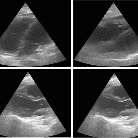 Echocardiogram Showing Areas Of Regional Wall Motion Abnormalities