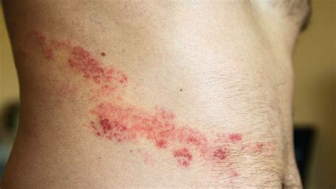 Another 10 Common Skin Rashes With Photos Health Service Navigator
