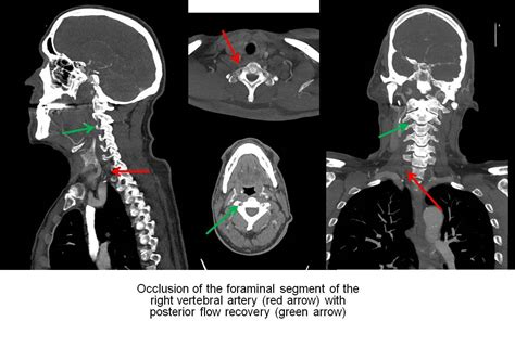 Vertebral Artery Dissection As A Cause Of Cervical Pain Serau Hot Sex Picture