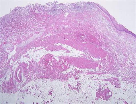 Retroperitoneal Cystic Masses Ct Clinical And Pathologic Findings