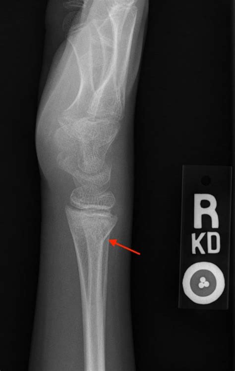 Unique Traumatic Fracture Patterns In Kids Uams Department Of Radiology
