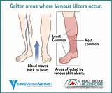 Best Treatment For Venous Stasis Ulcers Photos