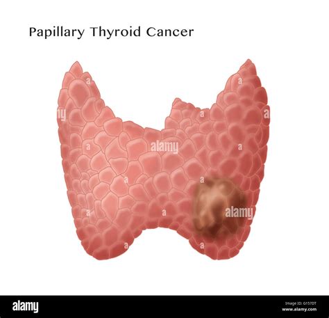 Labeled Illustration Showing Papillary Thyroid Cancer The Most Common