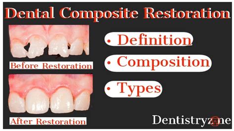 Dental Composite Restoration Composition Classification And Uses