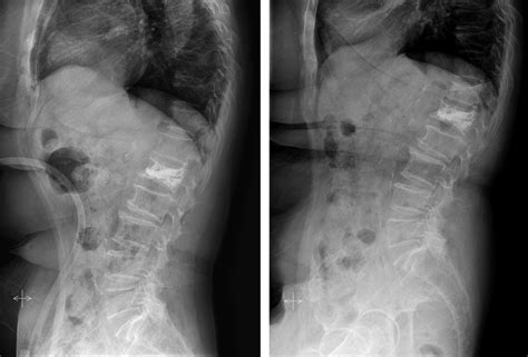 A A 67 Year Old Female With Vertebral Compression Fracture At L1 Was