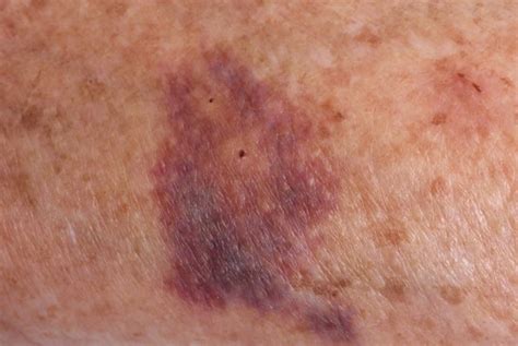 Purple Spots On Skin Pictures Small Purpura Causes Treatment
