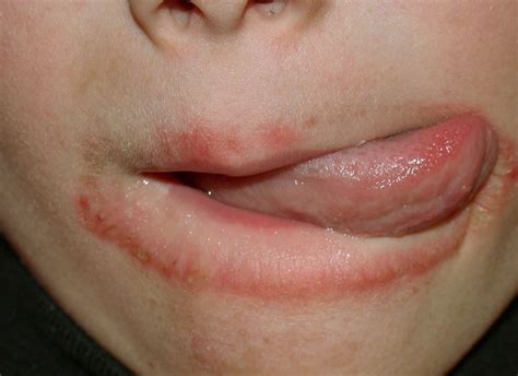 Eczema On Lips Medical Point