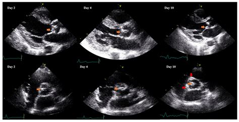 Figure 2 Transthoracic Echocardiography Images Top Row Is Parasternal