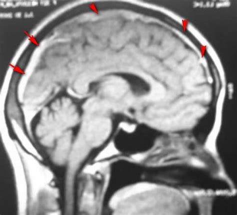 Trombosis De Los Senos Venosos Cerebrales EcuRed