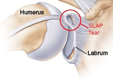 Slap Tear Causes Symptoms Treatment Of The Shoulder