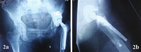 Ab X Ray For Cemented Revision Left Total Hip Replacement Showing