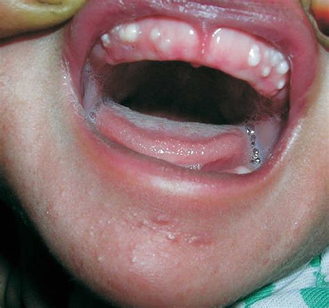 Epstein Pearls Causes Signs Symptoms Diagnosis And Treatment