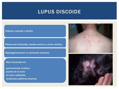 Lupus Eritematoso SistÉmico Criterios DiagnÓsticos